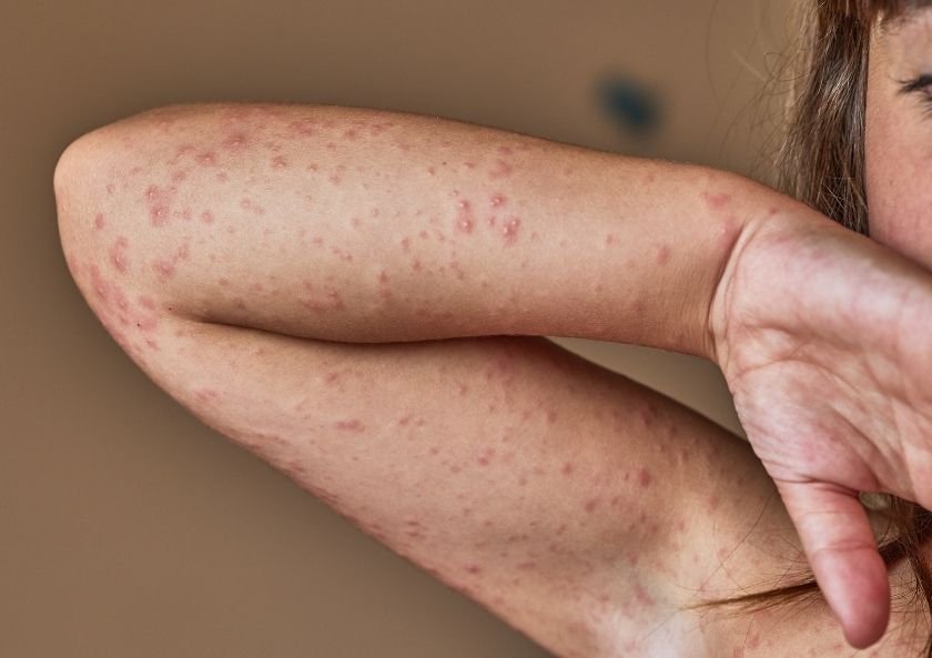 What is Urticaria and What are the Symptoms