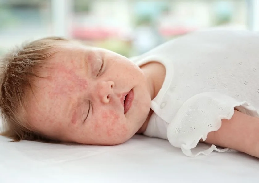 Eczema in Children