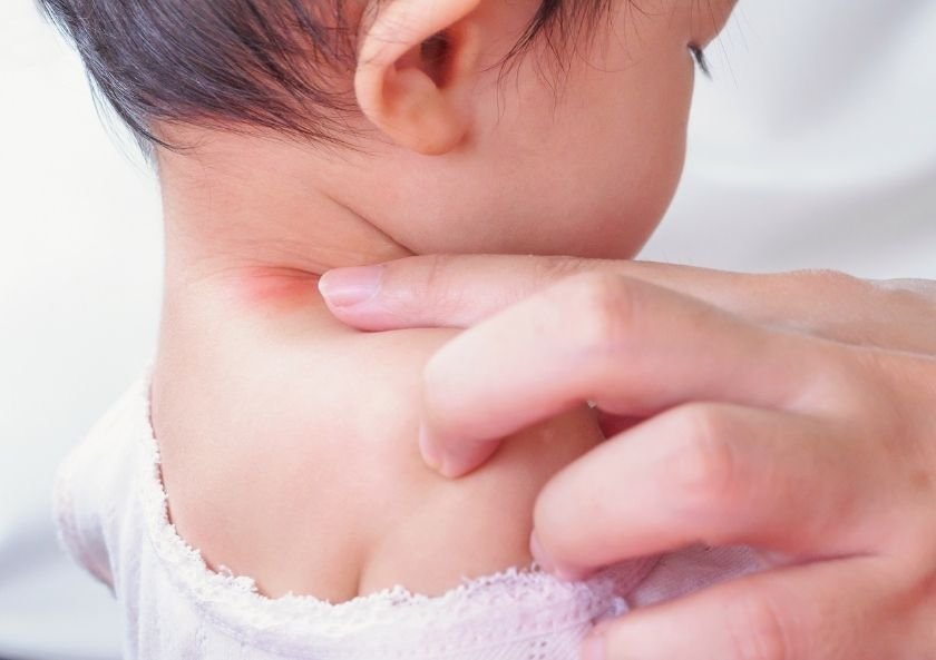 What are the Causes of Eczema (Atopic Dermatitis)
