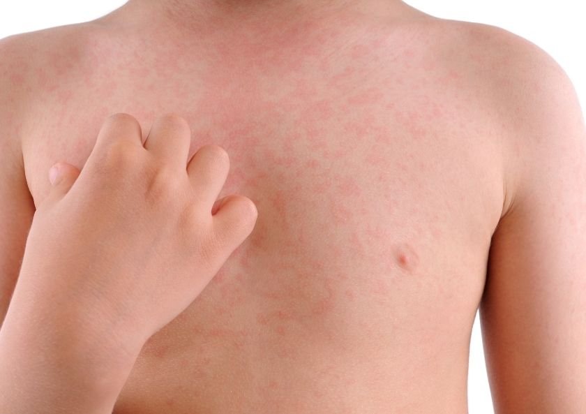 What are the causes of hives (urticaria)