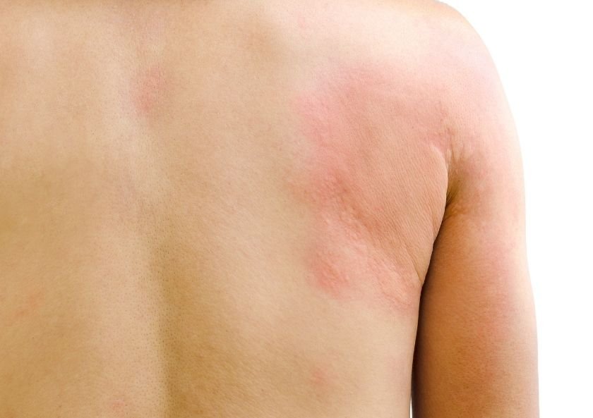 What is Hives (Urticaria)